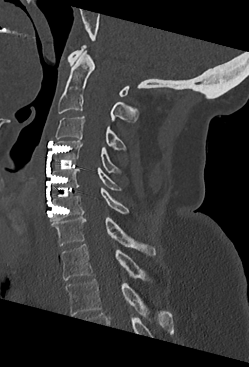 Cervical spine ACDF loosening (Radiopaedia 48998-54070 Sagittal bone window 45).png