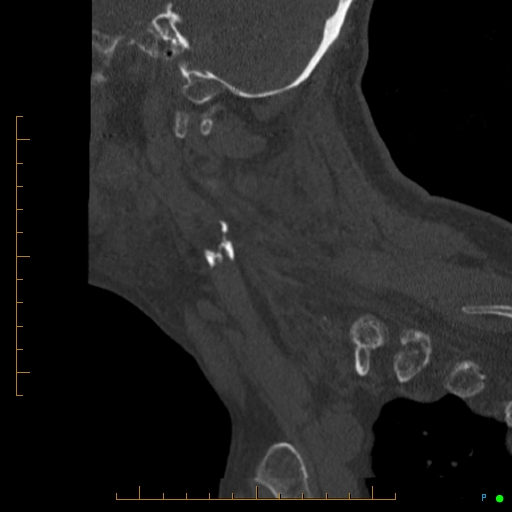Cervical spine fracture - ankylosing spondylitis (Radiopaedia 76835-88706 Sagittal bone window 89).jpg