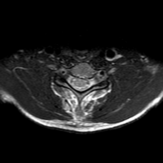 File:Cervical spine posterior ligamentous complex rupture (Radiopaedia 63486-72103 Axial T2 6).jpg