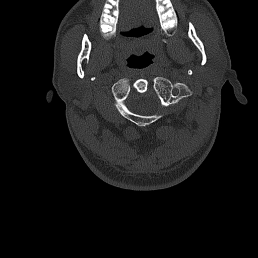 File:Cervical spine trauma with tear drop fracture and perched facet joint (Radiopaedia 53989-60127 Axial bone window 19).jpg