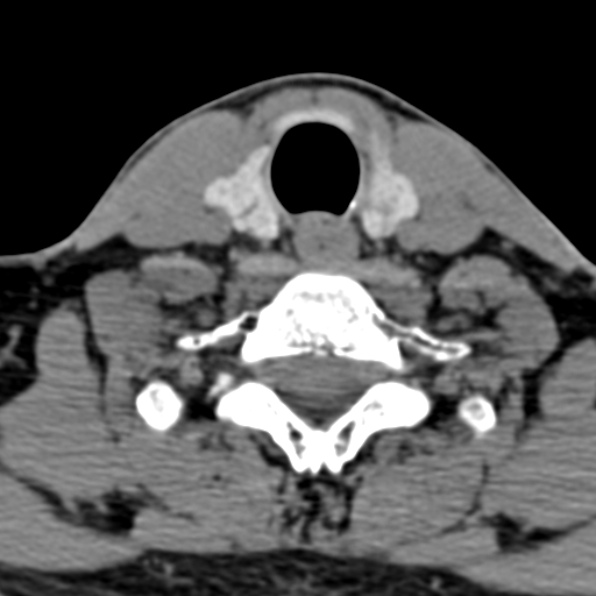 Cervical spondylodiscitis (Radiopaedia 28057-29489 Axial non-contrast 61).jpg
