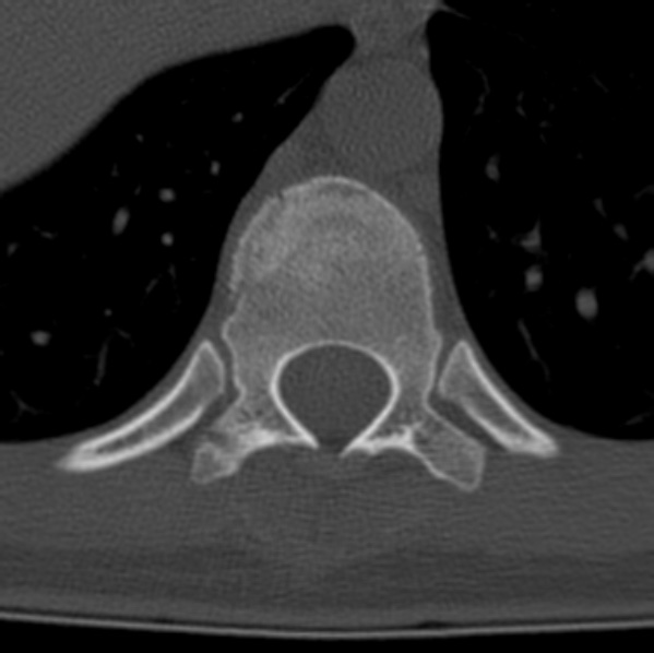 File:Chance fracture (Radiopaedia 36521-38081 Axial bone window 19).jpg