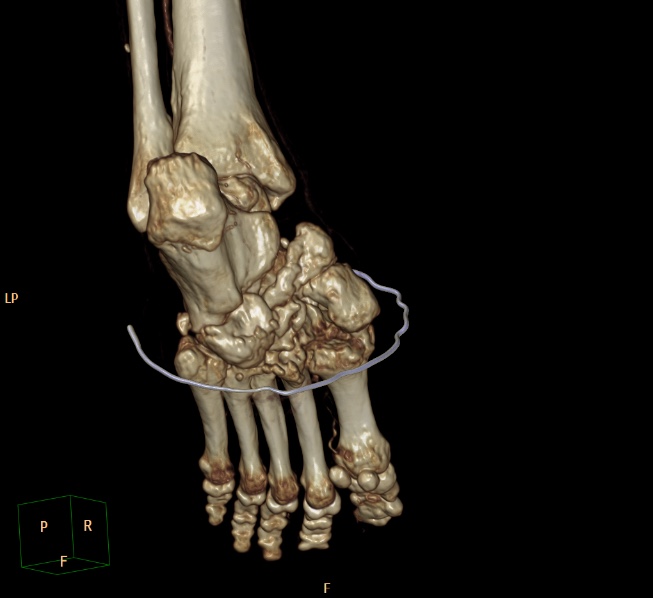 File:Charcot joint (Radiopaedia 36629-38194 3D bone window 7).jpg