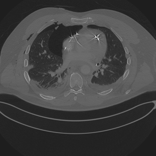 File:Chest multitrauma - aortic injury (Radiopaedia 34708-36147 Axial bone window 170).png