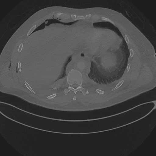 Chest multitrauma - aortic injury (Radiopaedia 34708-36147 Axial bone window 232).png