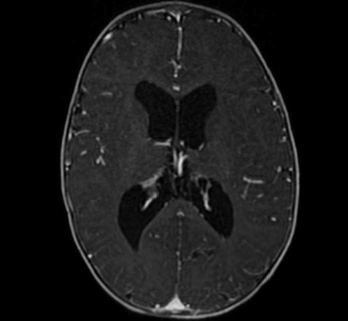 Chiasmatic-hypothalamic glioma (Radiopaedia 90079-107252 Axial T1 C+ 51).jpg