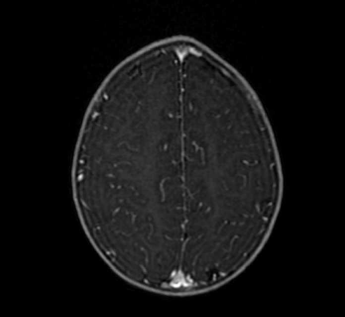 Chiasmatic-hypothalamic glioma (Radiopaedia 90079-107252 Axial T1 C+ 72).jpg