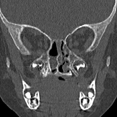 Choanal atresia (Radiopaedia 88525-105975 Coronal bone window 60).jpg