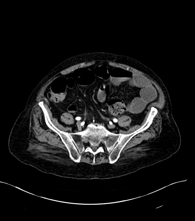 Cholangiocarcinoma with cerebral metastases (Radiopaedia 83519-98629 B 92).jpg