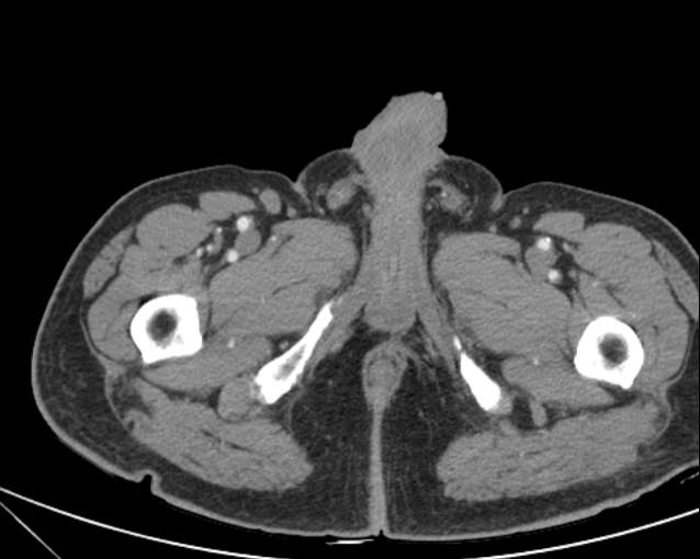 File:Cholecystitis - perforated gallbladder (Radiopaedia 57038-63916 A 89).jpg