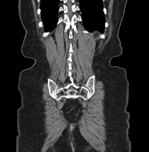 File:Cholecystoduodenal fistula due to calculous cholecystitis with gallstone migration (Radiopaedia 86875-103077 B 41).jpg