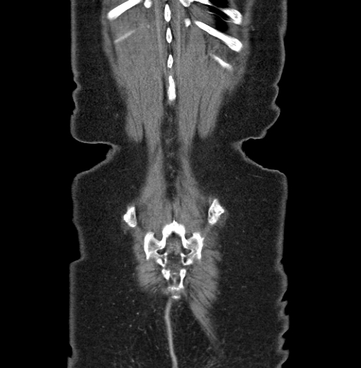 File:Cholecystoduodenal fistula due to calculous cholecystitis with gallstone migration (Radiopaedia 86875-103077 B 44).jpg