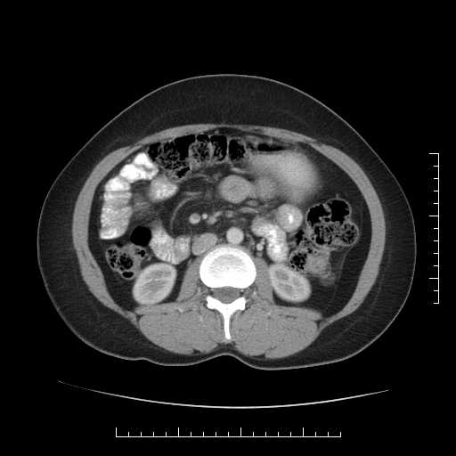 File:Choledochal cyst with chronic calcific pancreatitis (Radiopaedia 18245-18061 A 19).png