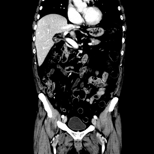 Choledocholiathiasis with normal caliber common bile duct (Radiopaedia 75368-86632 Coronal liver window 57).jpg