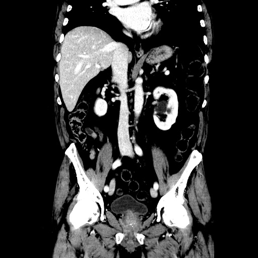 Choledocholiathiasis with normal caliber common bile duct (Radiopaedia 75368-86632 Coronal liver window 69).jpg