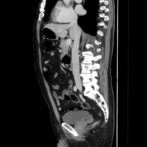 Choledocholiathiasis with normal caliber common bile duct (Radiopaedia 75368-86632 D 77).jpg