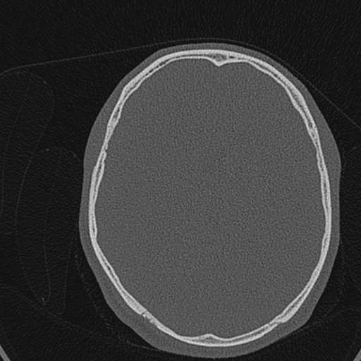 Cholesteatoma (Radiopaedia 70429-80529 Axial bone window 163).jpg