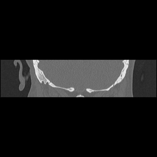 Cholesteatoma (Radiopaedia 84946-100455 Coronal bone window 126).jpg