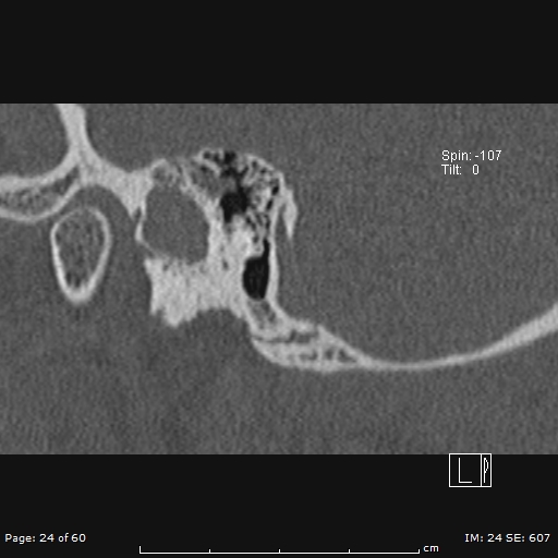 Cholesteatoma - external auditory canal (Radiopaedia 88452-105096 Sagittal bone window 24).jpg