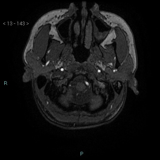 File:Cholesterol granuloma of the petrous apex (Radiopaedia 64358-73140 Axial TOF 3D 69).jpg