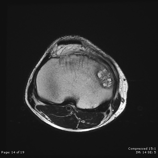 File:Chondroblastoma (Radiopaedia 25725-25891 Axial T2 14).jpg