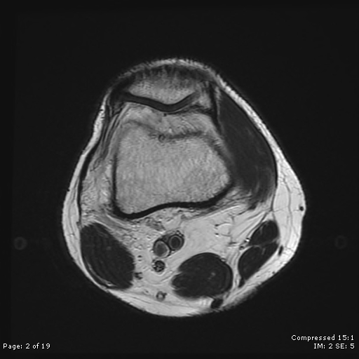 File:Chondroblastoma (Radiopaedia 25725-25891 Axial T2 2).jpg