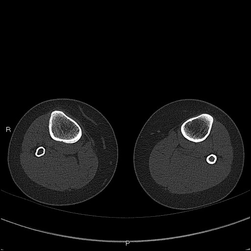 Chondroblastoma (Radiopaedia 62721-71030 Axial bone window 107).jpg