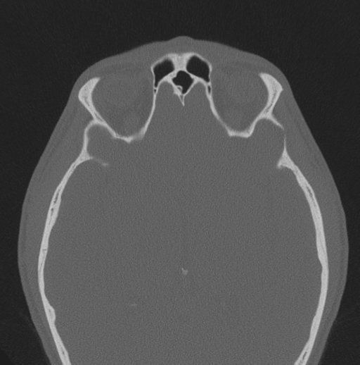 Chondrosarcoma (clivus) (Radiopaedia 46895-51425 Axial bone window 14).png