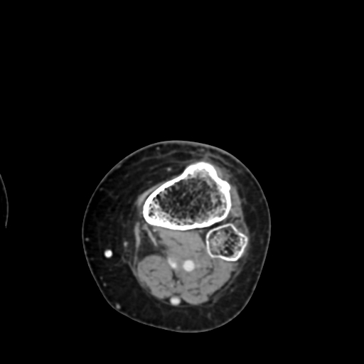 File:Chondrosarcoma - femur (Radiopaedia 64187-72954 Axial with contrast 73).jpg