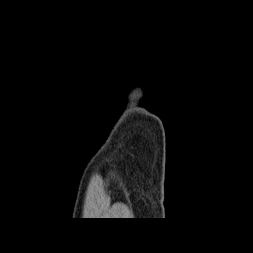 Chondrosarcoma of iliac wing (Radiopaedia 63861-72599 F 175).jpg