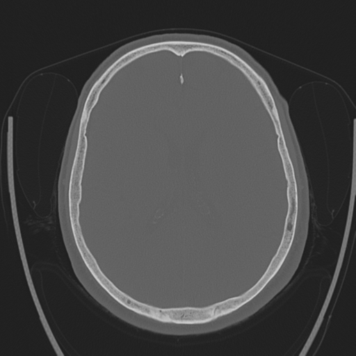Chondrosarcoma of skull base- grade II (Radiopaedia 40948-43653 Axial bone window 29).png