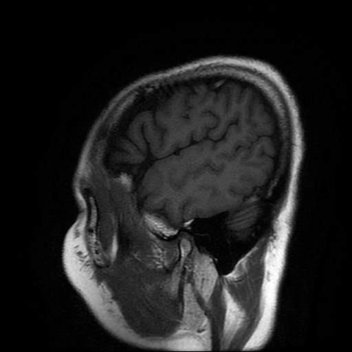File:Chordoid glioma of third ventricle (Radiopaedia 91612-109340 Sagittal T1 24).jpg