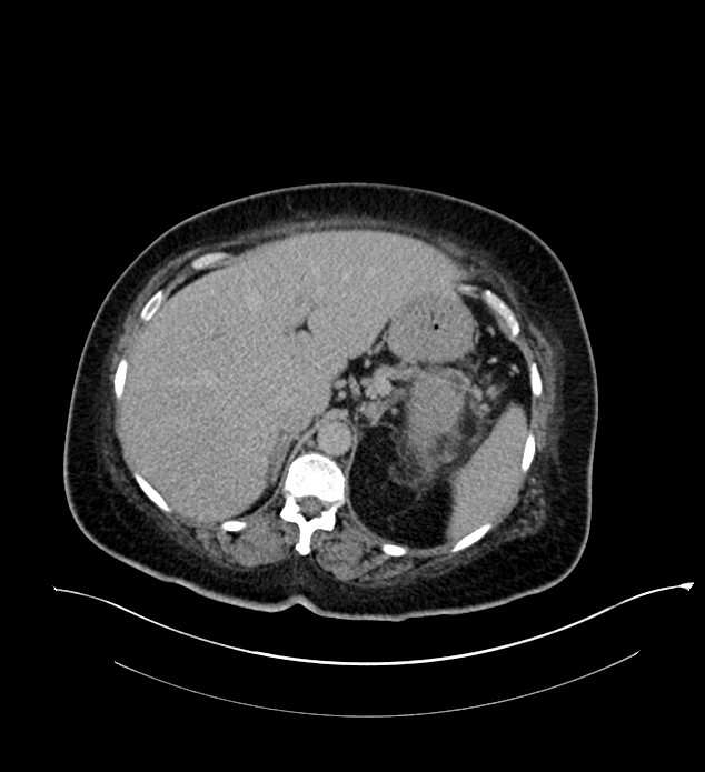 Chromophobe renal cell carcinoma (Radiopaedia 84239-99519 E 49).jpg