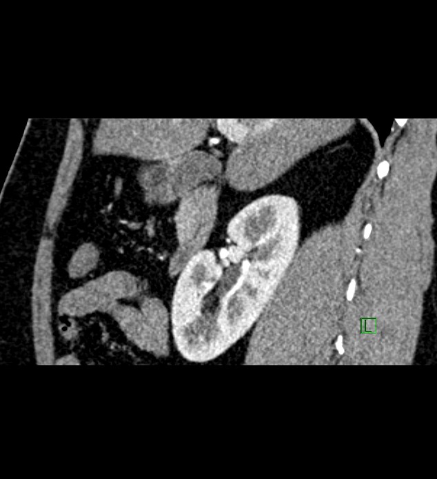 Chromophobe renal cell carcinoma (Radiopaedia 84286-99573 F 112).jpg