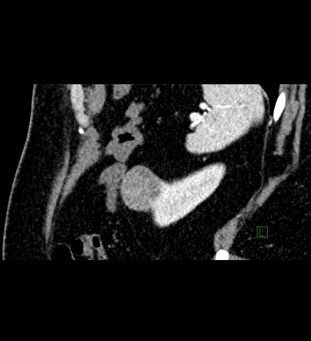 Chromophobe renal cell carcinoma (Radiopaedia 84286-99573 F 27).jpg