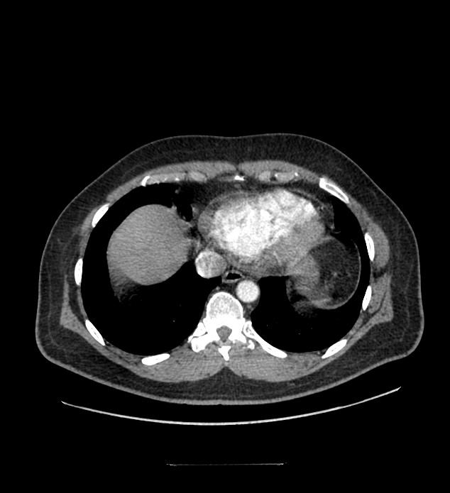 Chromophobe renal cell carcinoma (Radiopaedia 84337-99644 B 4).jpg