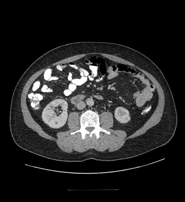 Chromophobe renal cell carcinoma (Radiopaedia 84337-99644 C 66).jpg