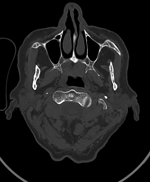 Chronic bilateral subdural hygroma (Radiopaedia 85801-101623 Axial bone window 118).jpg