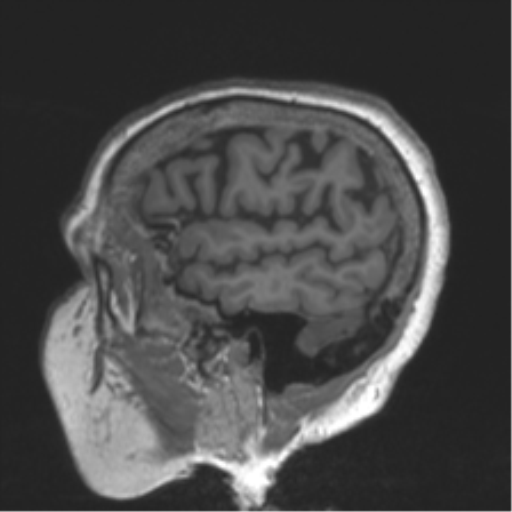 Chronic hypertensive encephalopathy (Radiopaedia 39993-42482 Sagittal T1 76).png
