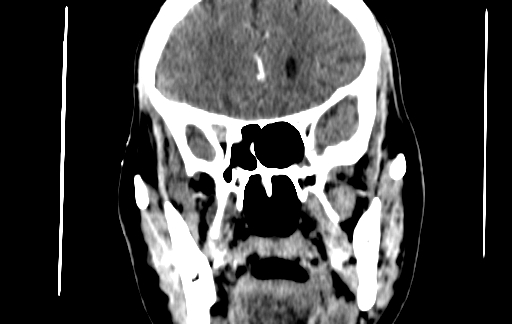Chronic invasive fungal sinusitis (Radiopaedia 91563-109286 D 75).jpg