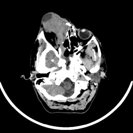 File:Chronic invasive fungal sinusitis with intraorbital and intracranial extension (Radiopaedia 56387-63046 Axial non-contrast 108).jpg
