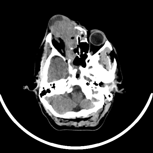 Chronic invasive fungal sinusitis with intraorbital and intracranial extension (Radiopaedia 56387-63046 Axial non-contrast 116).jpg