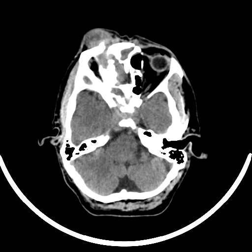 File:Chronic invasive fungal sinusitis with intraorbital and intracranial extension (Radiopaedia 56387-63046 Axial non-contrast 133).jpg