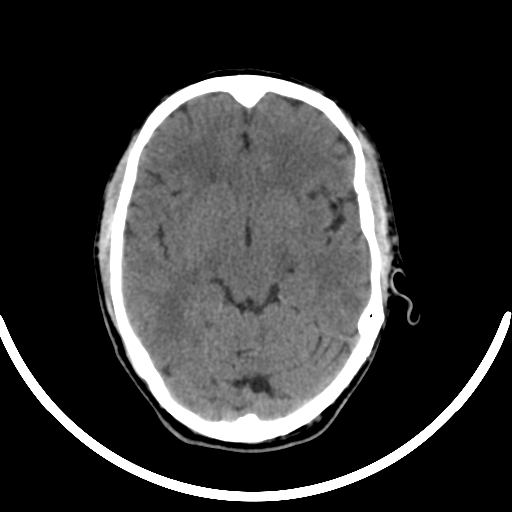 File:Chronic invasive fungal sinusitis with intraorbital and intracranial extension (Radiopaedia 56387-63046 Axial non-contrast 179).jpg