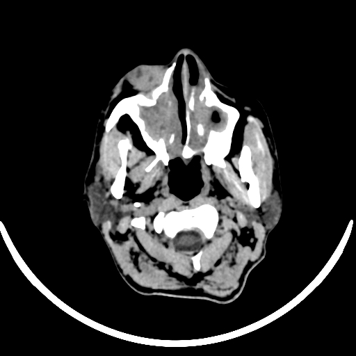 File:Chronic invasive fungal sinusitis with intraorbital and intracranial extension (Radiopaedia 56387-63046 Axial non-contrast 51).jpg