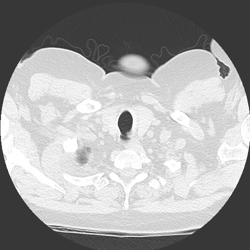 File:Chronic lung allograft dysfunction - restrictive form (Radiopaedia 60595-68316 Axial lung window 2).jpg