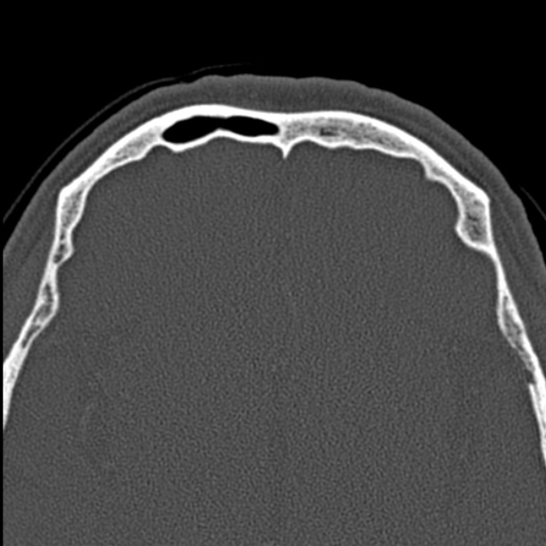 Chronic maxillary sinusitis (Radiopaedia 27879-28116 Axial bone window 51).jpg