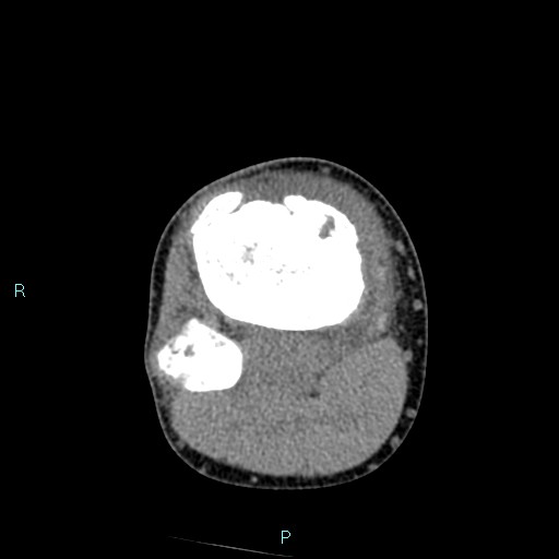 Chronic osteomyelitis (with Brodie abscess) (Radiopaedia 76405-88111 A 80).jpg