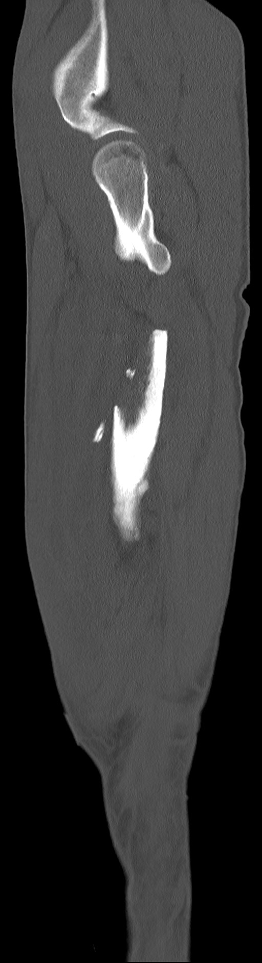 Chronic osteomyelitis (with sequestrum) (Radiopaedia 74813-85822 C 90).jpg