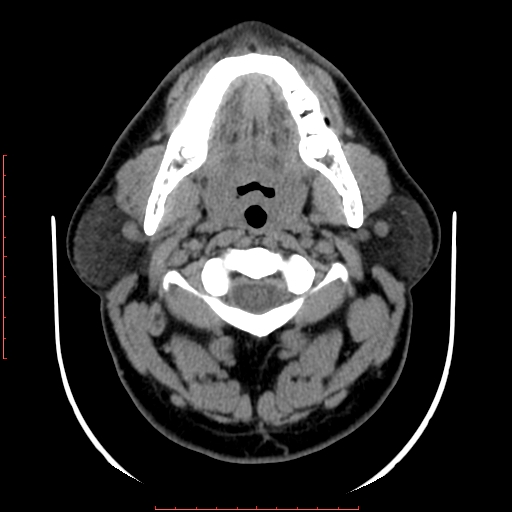 Chronic submandibular sialolithiasis (Radiopaedia 69817-79814 Axial non-contrast 75).jpg